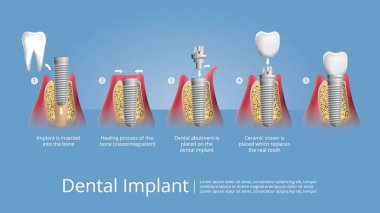 İnsan dişleri ve diş implantı Vektör İllüstrasyonu