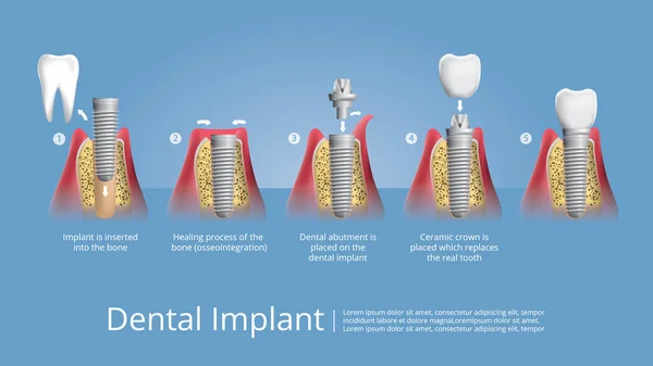 Dentes Humanos Implante Dentário Ilustração Vetorial — Vetor de Stock