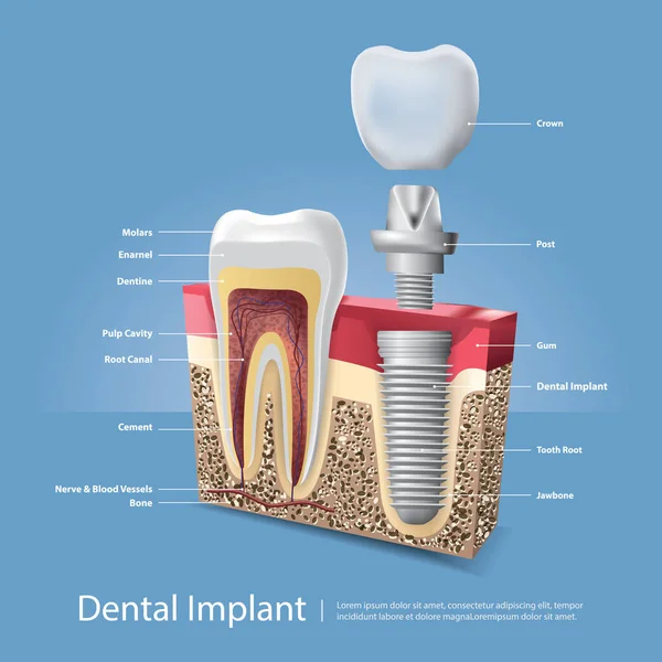 Denti Umani Impianto Dentale Vettore Illustrazione — Vettoriale Stock