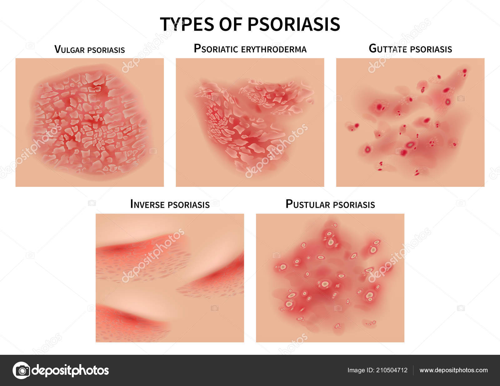 teljes psoriasis kezelsi rend viszkető vörös foltok a kezeken és a lábakon