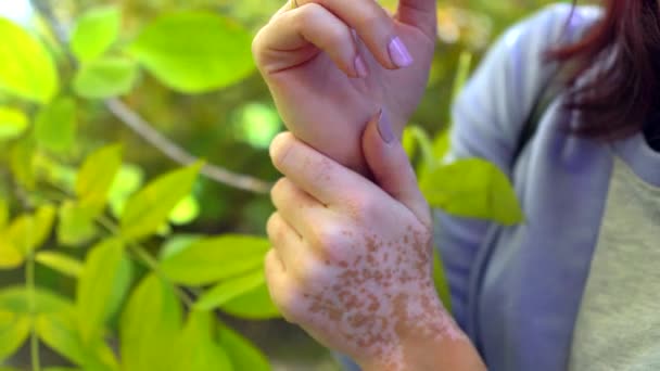 Tangan seorang wanita muda dengan penyakit kulit — Stok Video