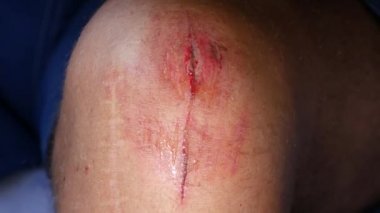 Doktor tıbbi dezenfektan kullanılarak bir ayak yara temizleme