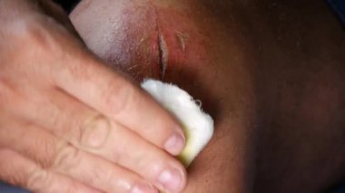 Adam tıbbi bir çözüm ayak yaraya Uygulama Bakımı