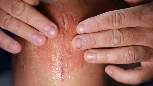 Médico Manos Chequeando Pie Sangrando Herida — Vídeos de Stock