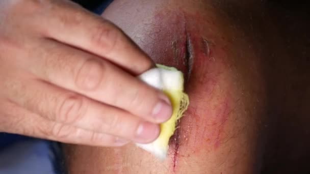 Man Verzorging Van Zijn Been Wond Met Behulp Van Bandage — Stockvideo