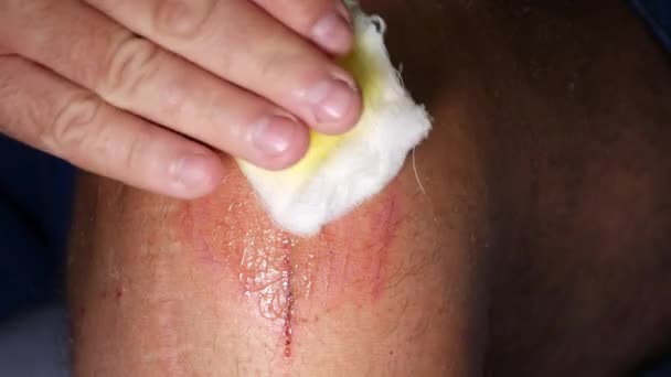 Man Hospital Taking Care Knee Wound Put Antibiotics Clean Bandage — Stock Video