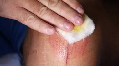 Doktor hastanede temiz su depolarını dezenfekte edip bir yaralı ayak bandaj