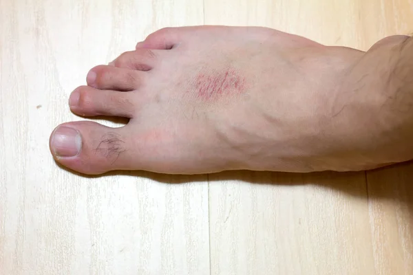 木材背景下男性足部干性皮肤和皮疹 — 图库照片