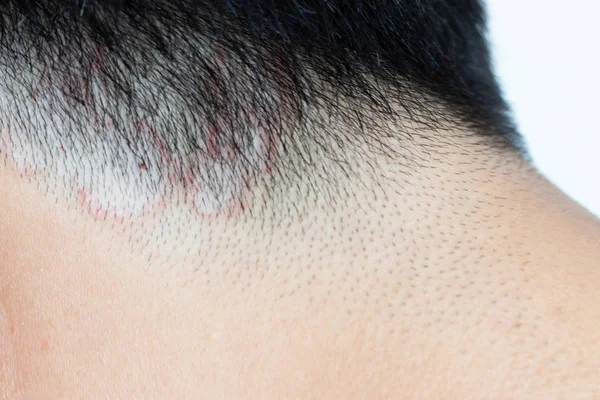 Verschluss Des Ringelwurms Tinea Kopf Des Asiatischen Mannes Dermatitis — Stockfoto