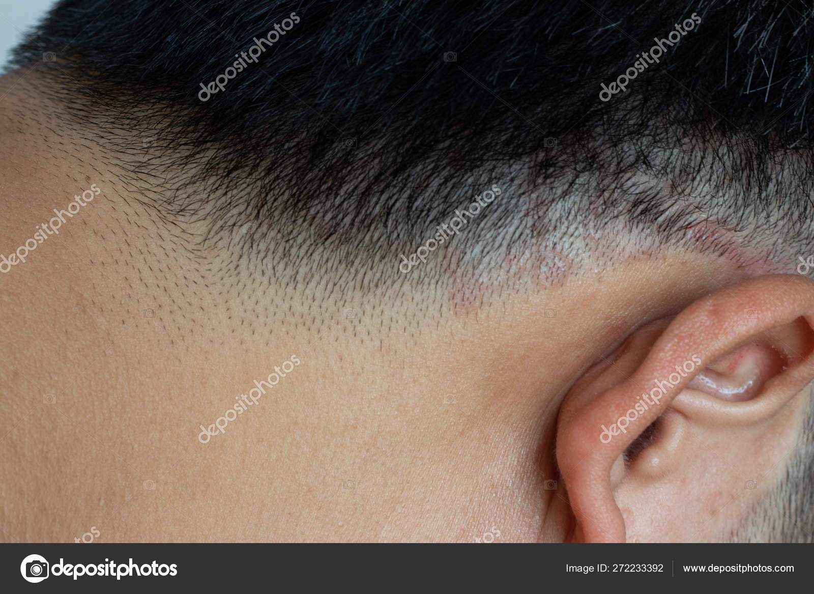 Closed up of ringworm (tinea) on head of asian man (Dermatitis) Stock Photo  by © 272233392