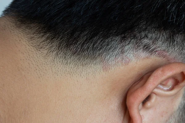 Ditutup dari cacing gelang (tinea) pada kepala manusia asia (Dermatitis ) — Stok Foto
