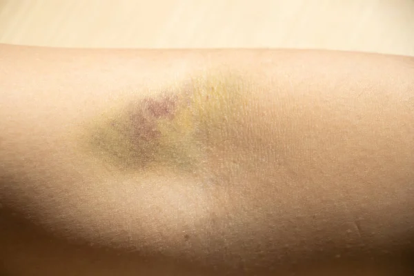 Herida por moretones en el fondo del brazo femenino —  Fotos de Stock