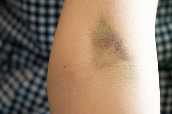 Τραυματισμός μώλωπα στο γυναικείο φόντο του βραχίονα — Φωτογραφία Αρχείου
