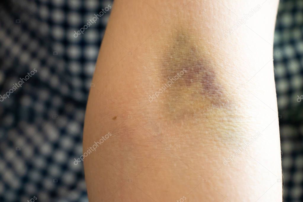 Bruise injury on the female arm background
