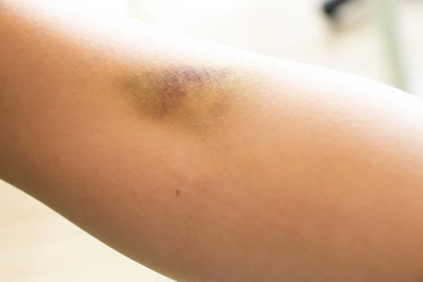 Modřiny zranění na ženském pozadí paže — Stock fotografie