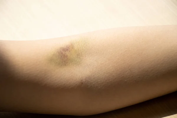 Cedera Memar Pada Latar Belakang Lengan Wanita — Stok Foto