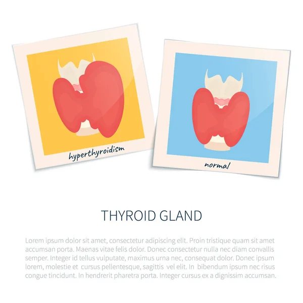Гипертиреоз и здоровая щитовидная железа — стоковый вектор