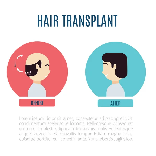 Infografías Trasplante Capilar Paciente Con Alopecia Antes Después Del Procedimiento — Archivo Imágenes Vectoriales