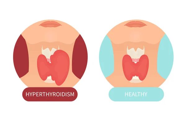 Female healthy thyroid and its disorder — Stock Vector