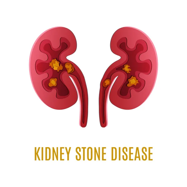 Kidney stone disease paper cut 3D poster — Stock Vector