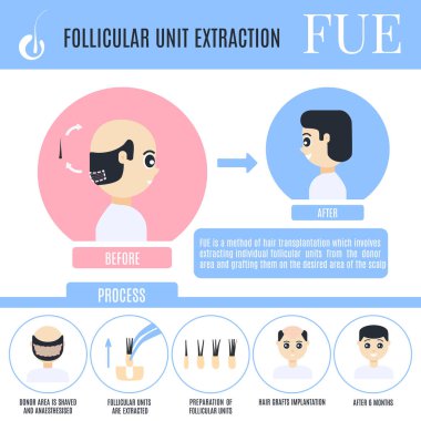 Foliküler ünite ekstraksiyon infographics erkek saç dökülmesi treatm için