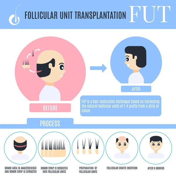 Erkek saç dökülmesi t için foliküler ünite transplantasyonu Infographics — Stok Vektör