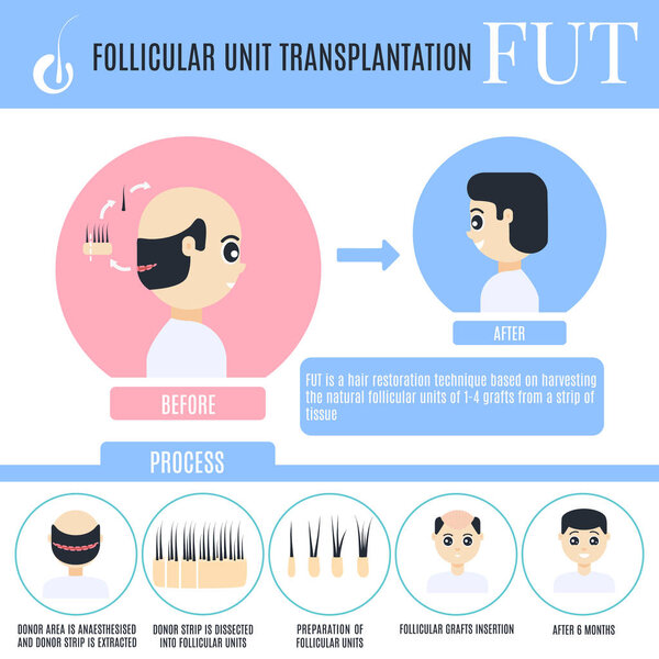 Инфографика трансплантации фолликулярной единицы для мужской алопеции t
