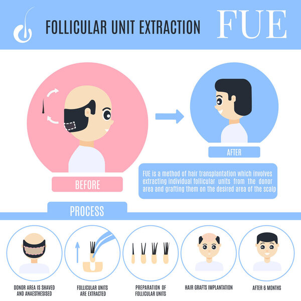 Follicular unit extraction infographics for male alopecia treatm