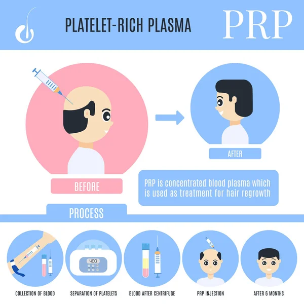 Destiček bohatý plazma infographics pro muž alopecie léčba — Stockový vektor