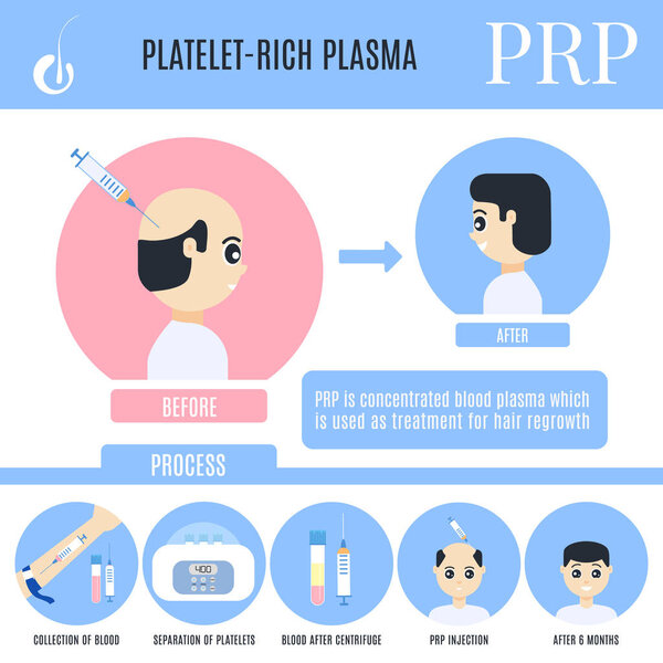 Platelet-rich plasma infographics for male alopecia treatment