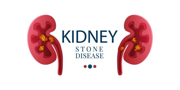 Kidney stone disease paper cut 3D poster — Stock Vector