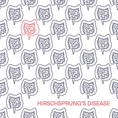 Hirschsprung'ın hastalık farkındalık poster. Kalın bağırsak kolon sinir hücrelerinin yokluğunda tarafından neden olduğu konjenital durumunu. Desen sağlıklı organlar ve bir hastalık tarafından etkilenen. IBD bozukluğu
