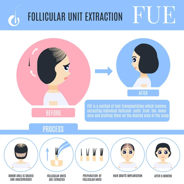 Unité Folliculaire Extraction Femelle Perte Cheveux Traitement Infographies Étapes Chirurgie — Image vectorielle