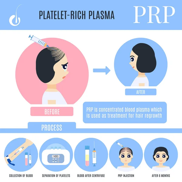 Plasma Rico Plaquetas Infográficos Tratamento Perda Cabelo Feminino Fases Procedimento — Vetor de Stock