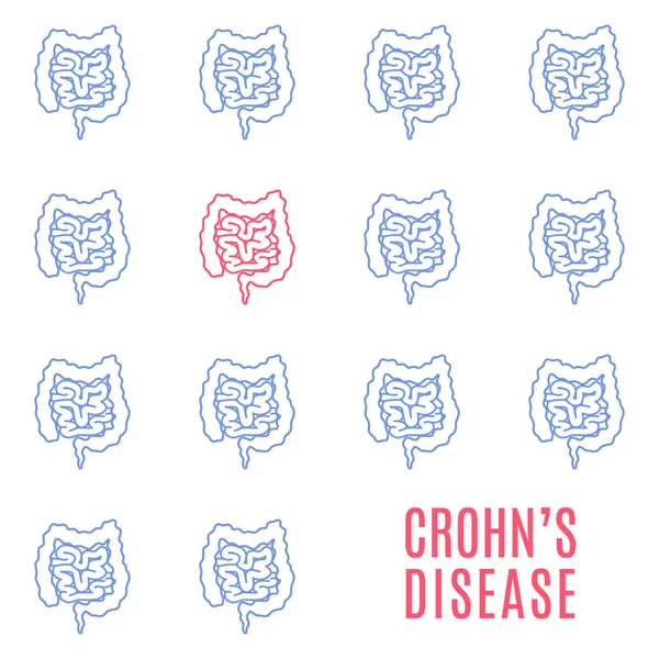 Crohns Ασθένεια Ευαισθητοποίησης Αφίσα Ιατρικό Πρότυπο Υγιή Έντερα Και Μία — Διανυσματικό Αρχείο