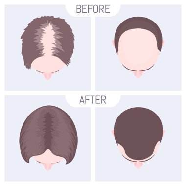 Kadın ve erkek tipi alopesi seti. Tıp eğitimi afişi