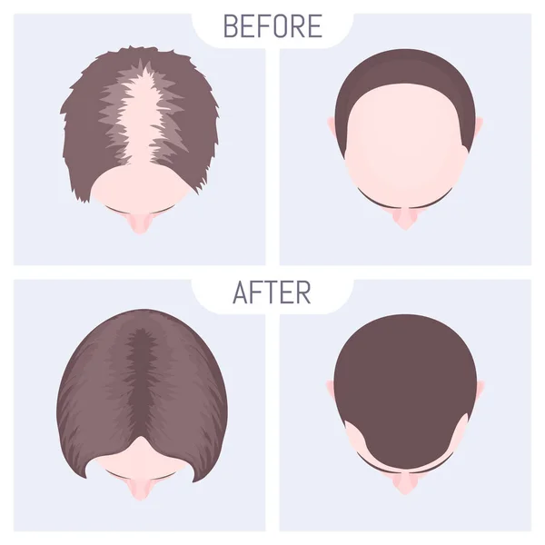 Conjunto de alopecia de patrón femenino y masculino. Cartel educativo médico — Vector de stock