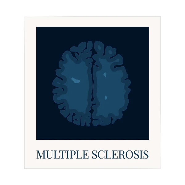 Resonancia magnética del cerebro afectado por esclerosis múltiple — Vector de stock