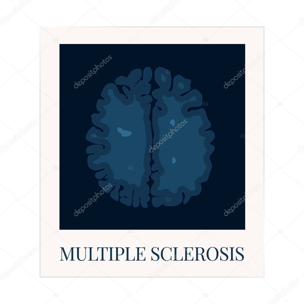 MRI scan of the brain affected by multiple sclerosis