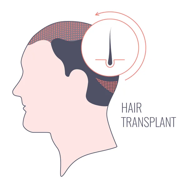 Trasplante de cabello en hombres plantilla médica lineal — Archivo Imágenes Vectoriales