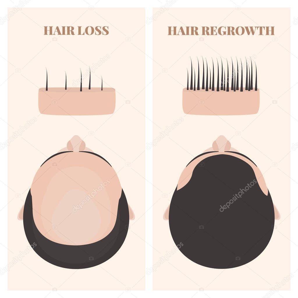 Man before and after hair regrowth transplantation