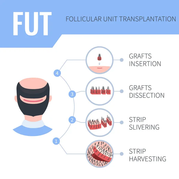 FUT hair transplantation medical infographics for men — Stock Vector