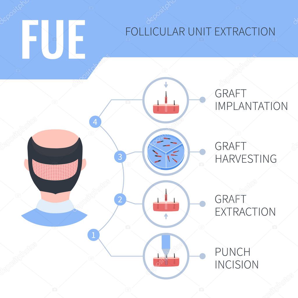 FUE hair transplantation medical infographics for men