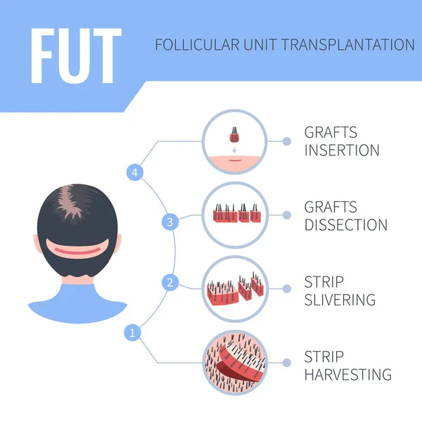 FUT hair transplantation medical infographics for women — Stock Vector