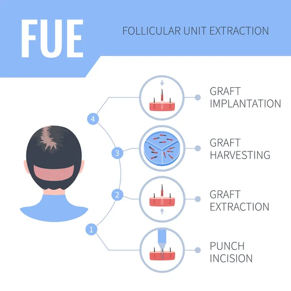 FUE transplantation de cheveux infographie médicale pour les femmes — Image vectorielle