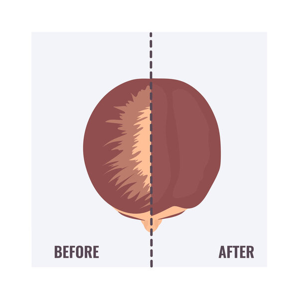 Balding woman before and after hair transplantation