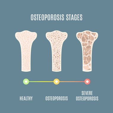 Osteoporoz kemik yoğunluğu kaybı hastalık tıbbi bilgi grafikleri