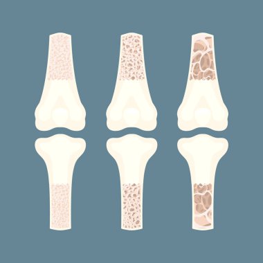 Osteoporoz kemik yoğunluğu kaybı hastalık tıbbi bilgi grafikleri