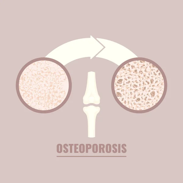 Osteoporos bentäthet förlust sjukdom medicinsk infographics — Stock vektor