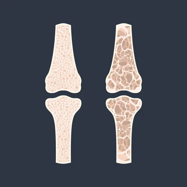 Osteoporosi perdita di densità ossea malattia infografica medica — Vettoriale Stock